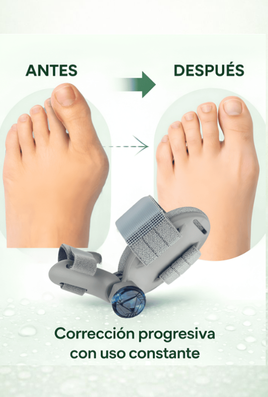 Corrector de Juanetes Alivy®  Alivie el dolor sin operación.